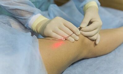 Behandlung von Krampfadern mit einem Laser