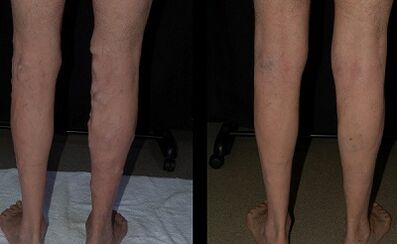 Behandlung von Krampfadern mit einem Laserfoto vor und nachher