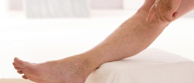 Krampfadern an den Beinen